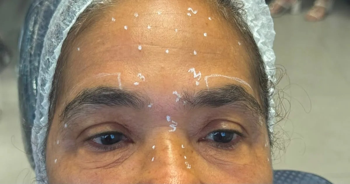 Marcação dos pontos de aplicação de botox na testa e na glabela, antes da sessão de toxina botulínica