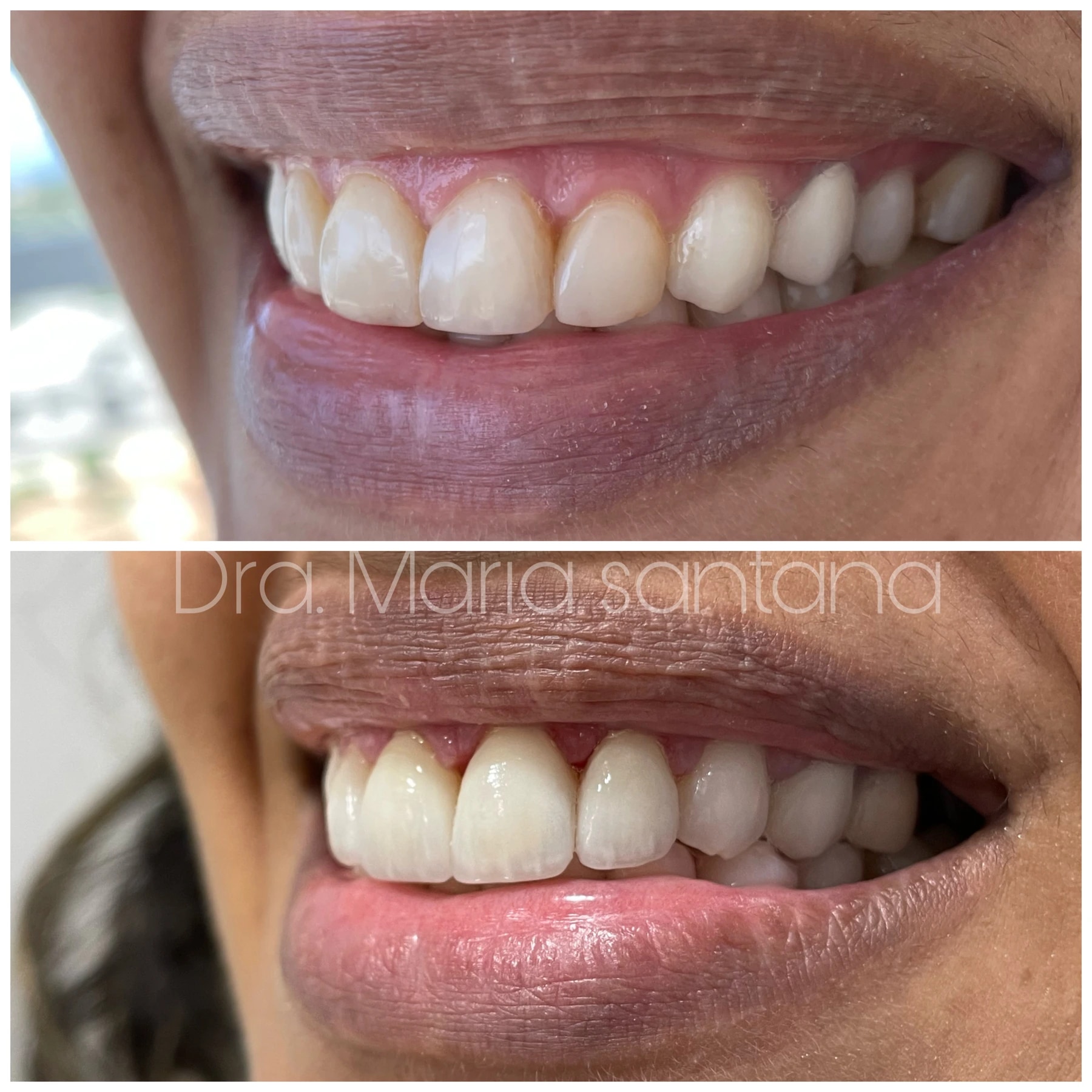 Lentes e Facetas Dentais